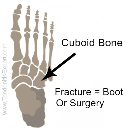 cuboid fracture healing
