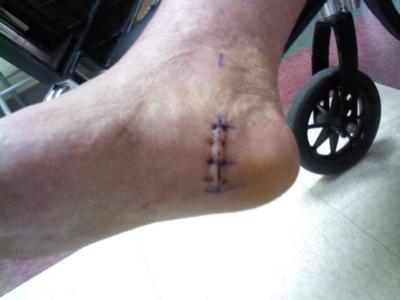 severe heel spur pain