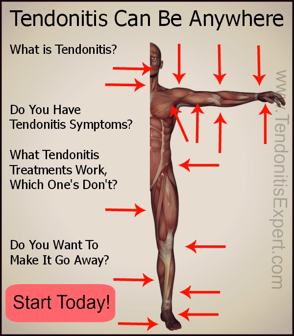 Tendonitis Information On Treatment Symptoms You Won t Find Anywhere Else